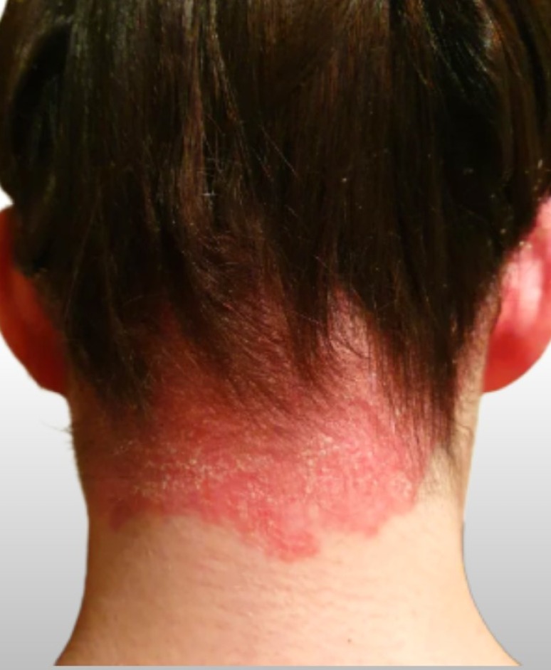 Scalp psoriasis before UVB phototherapy treatment