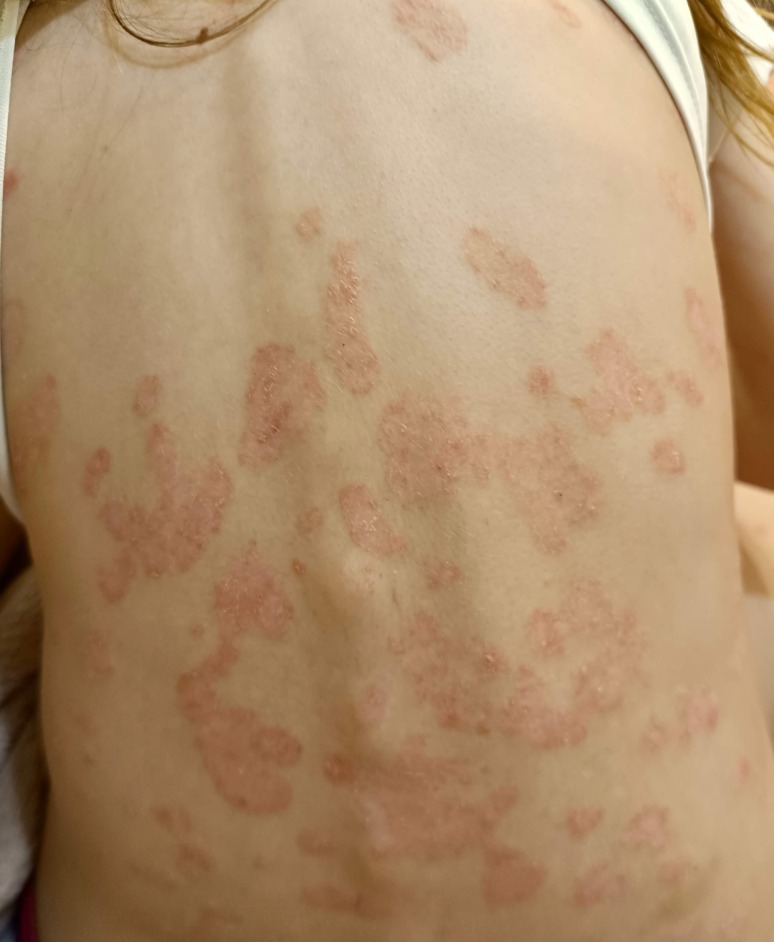 Psoriasis on the back before UVB light