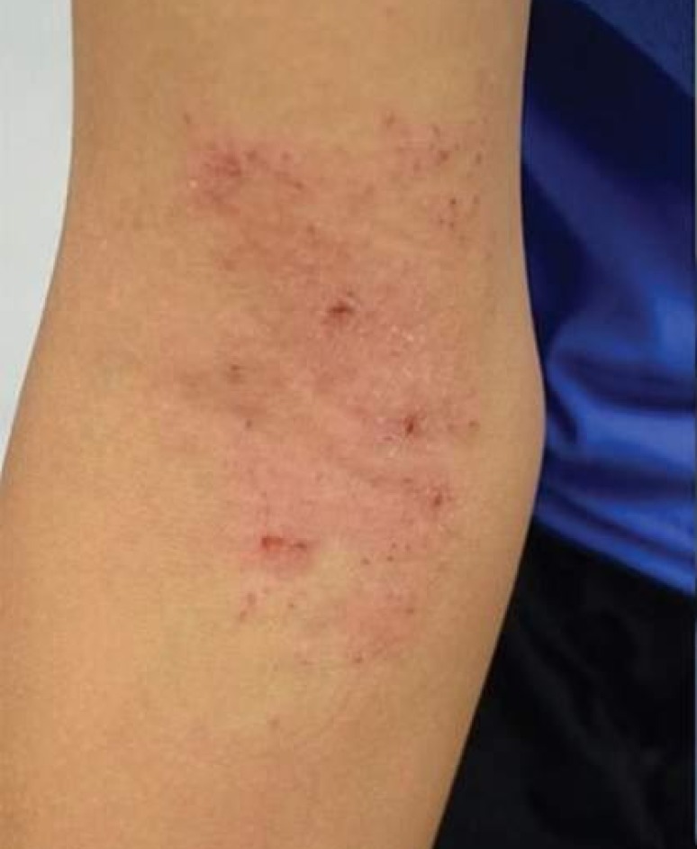Eczema that cannot be controlled with topical treatments