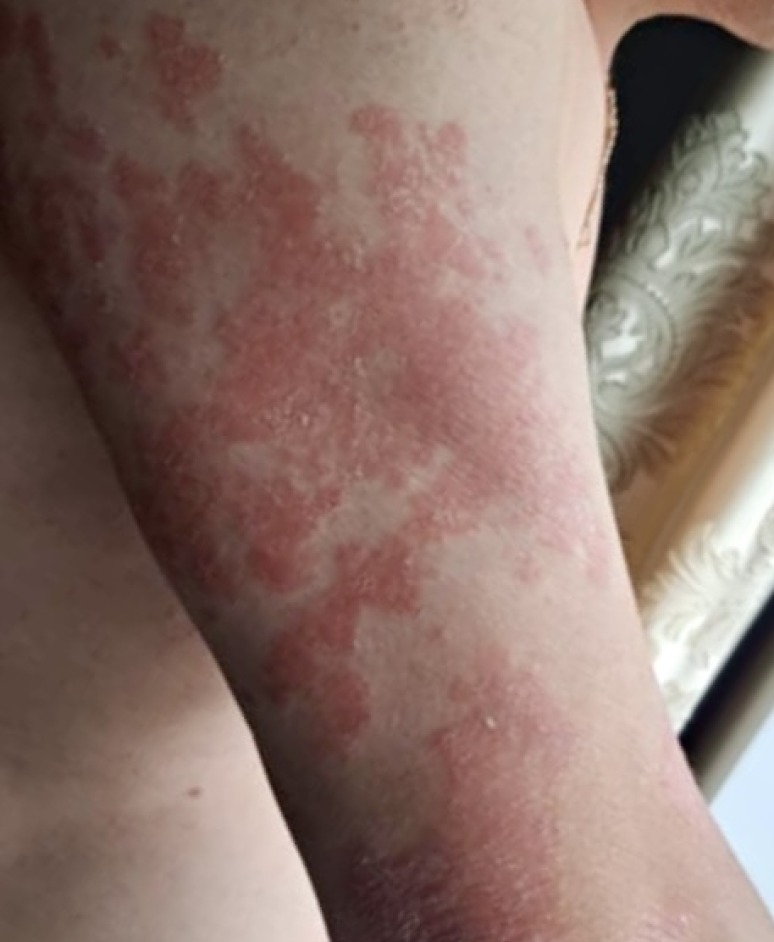 Severe Psoriasis on arms before patient started UV Tactus phototherapy treatment at home