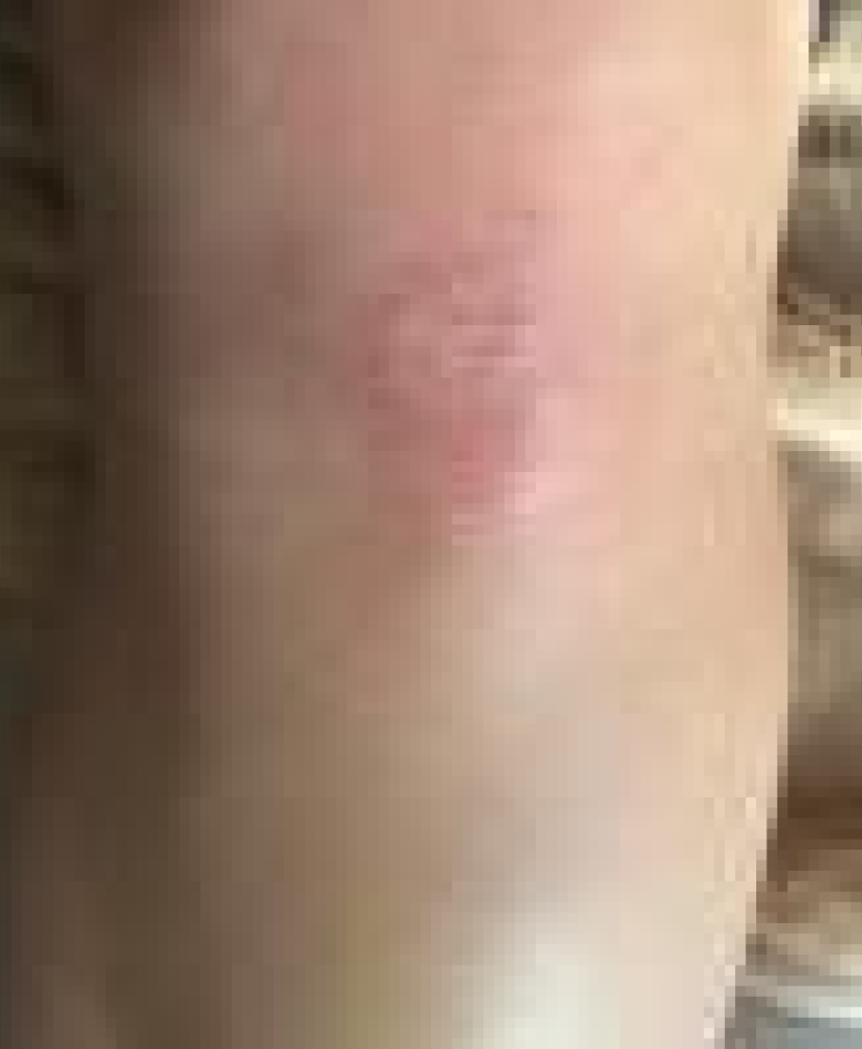 Psoriasis before narrowband UVB treatment