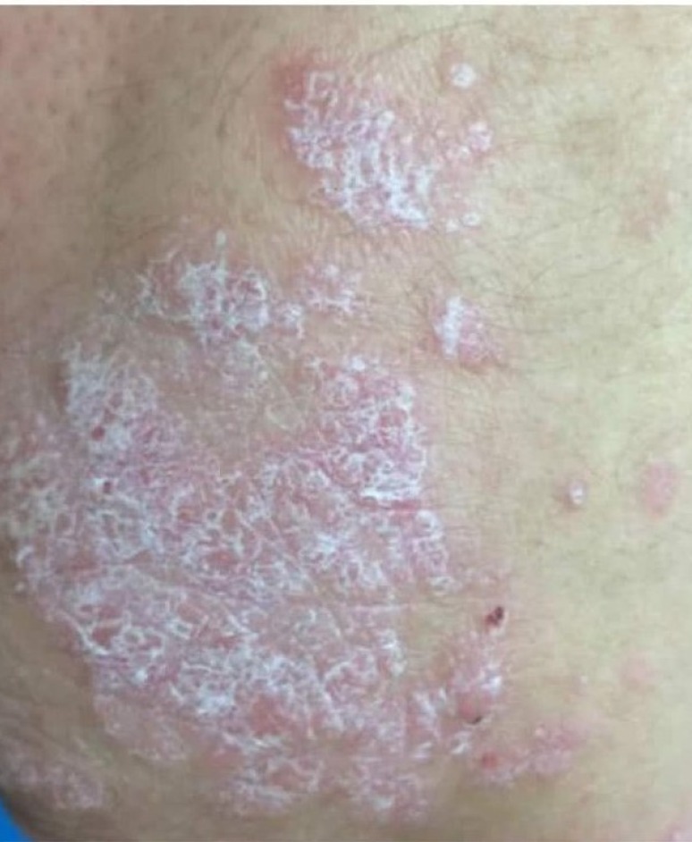 phototherapy psoriasis eczema vitiligo UVB 311 effective treatment at home digital 