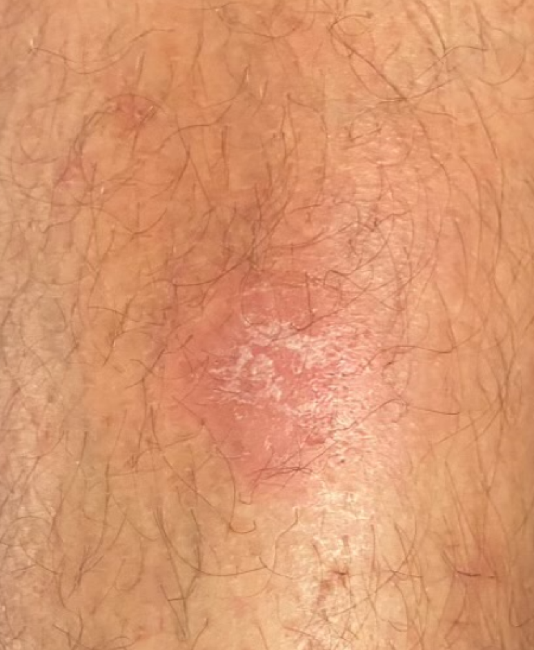 phototherapy psoriasis eczema vitiligo UVB 311 effective treatment at home digital 