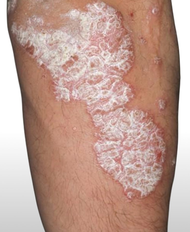 phototherapy psoriasis eczema vitiligo UVB 311 effective treatment at home digital 