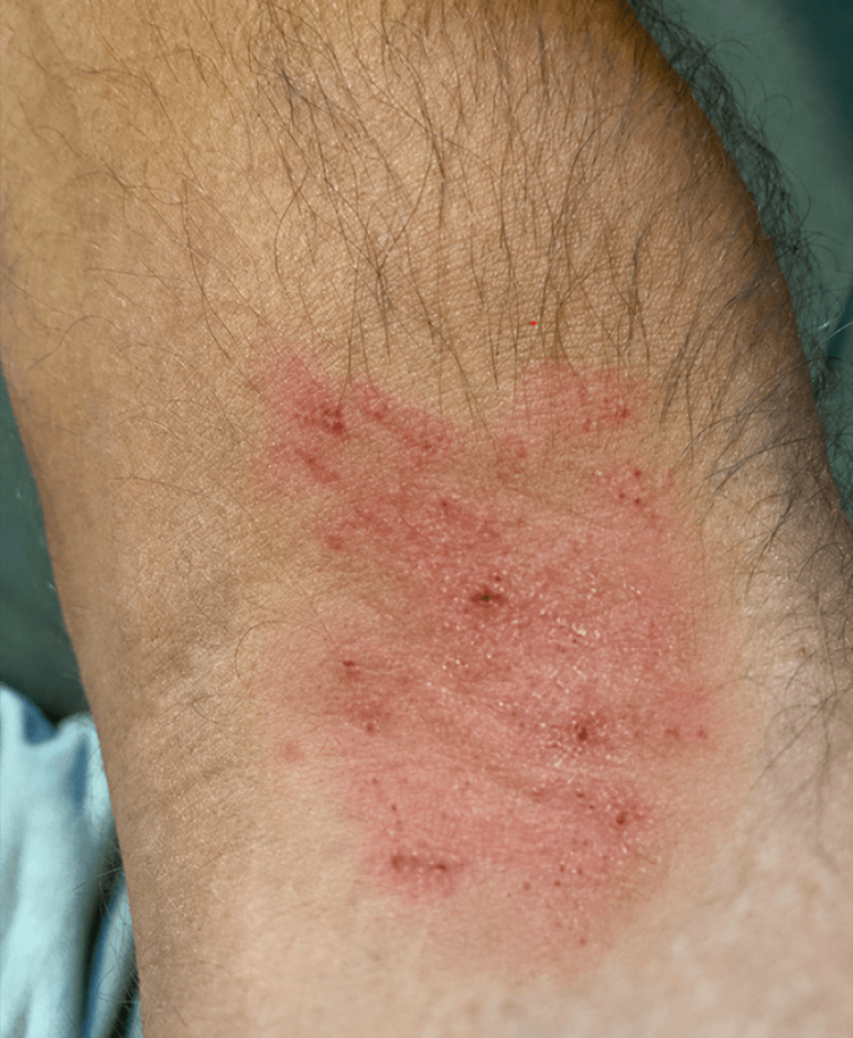 Eczema that cannot be controlled with topical treatments