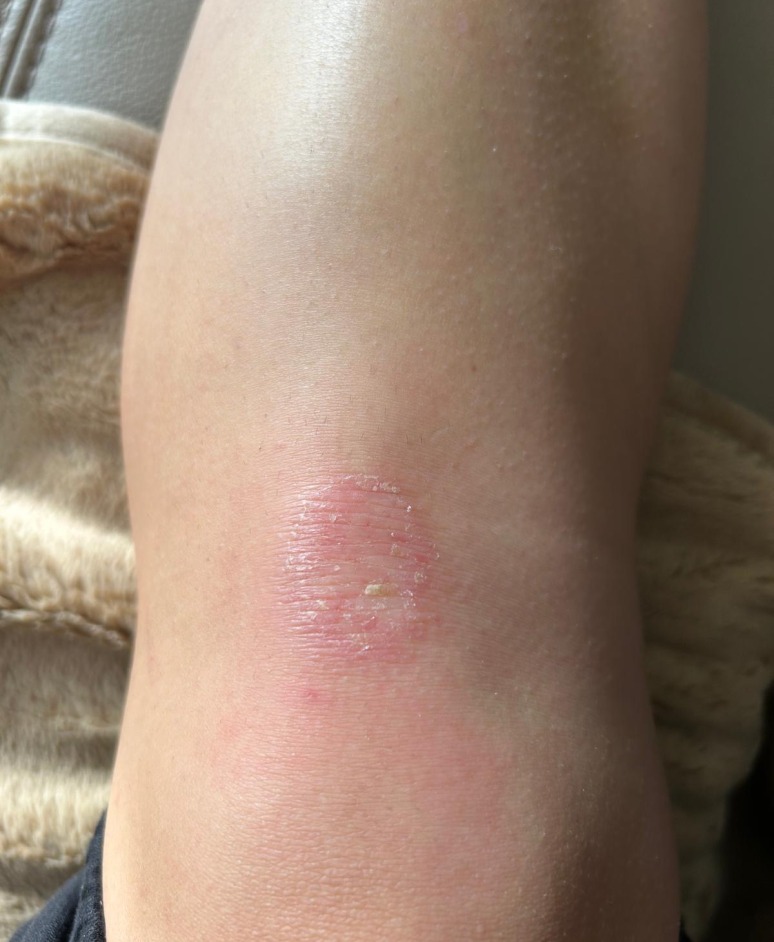 Psoriasis before narrowband UVB treatment