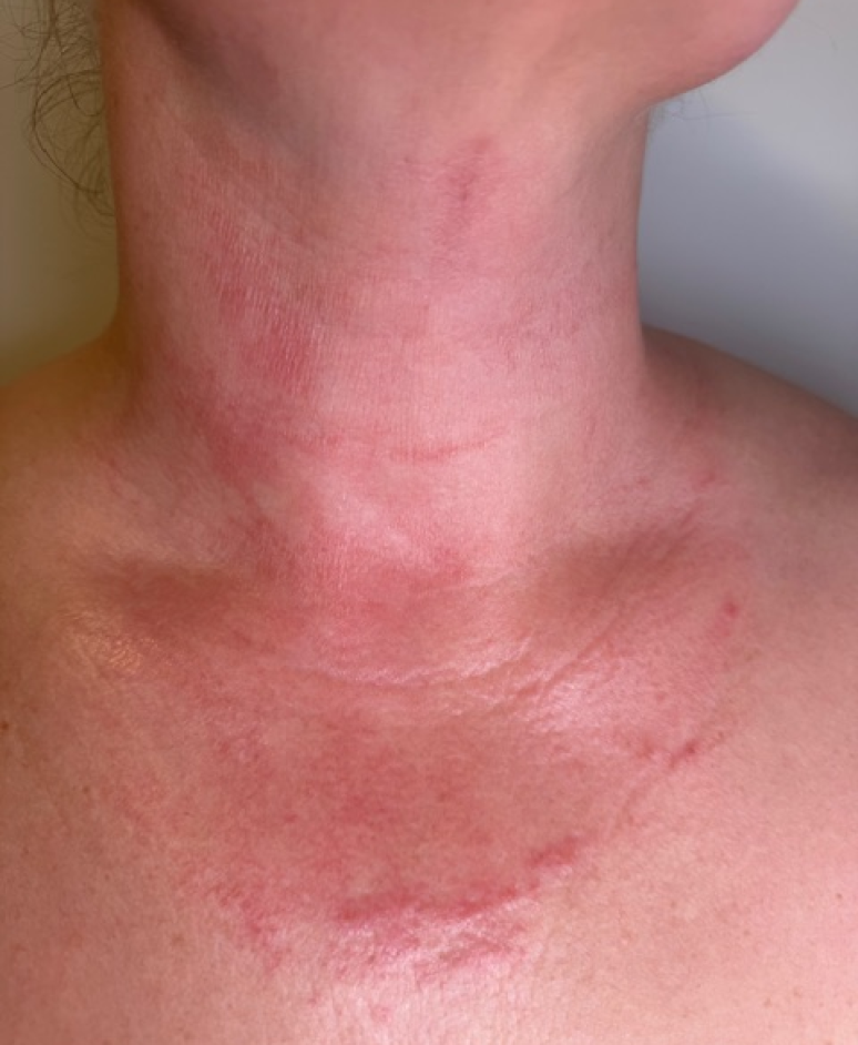 Contact dermatitis on the neck before light treatment