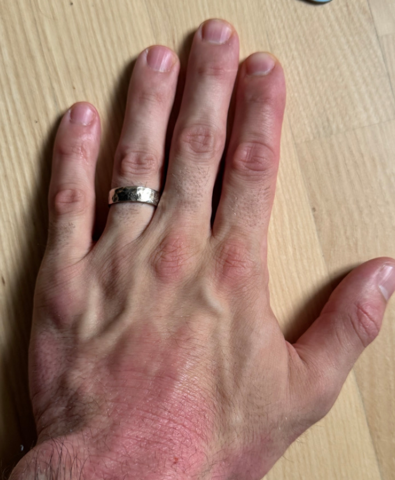 Ezcema flare before ultraviolet light treatment at home
