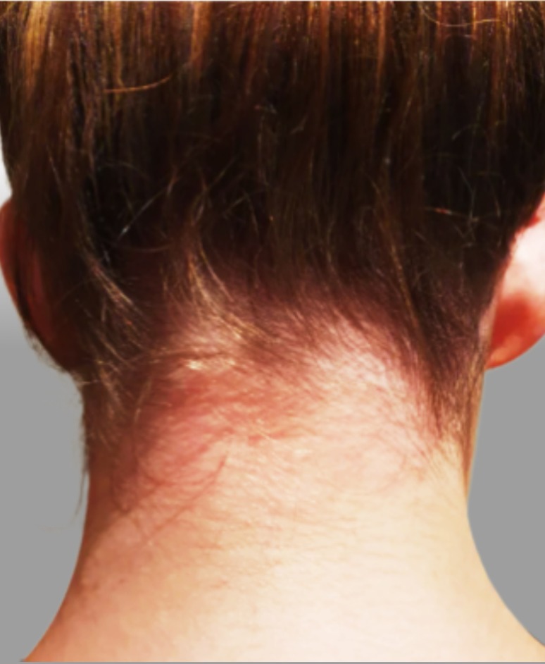 UVB light therapy results for treating scalp psoriasis with UV Tactus comb attachment