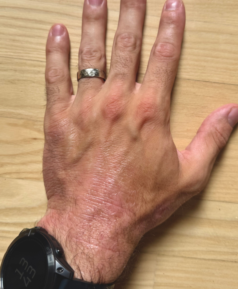 Eczema: Results of eczema treatment on hands for 8 weeks with the UV Tactus  narrowband UVB phototherapy device at home
