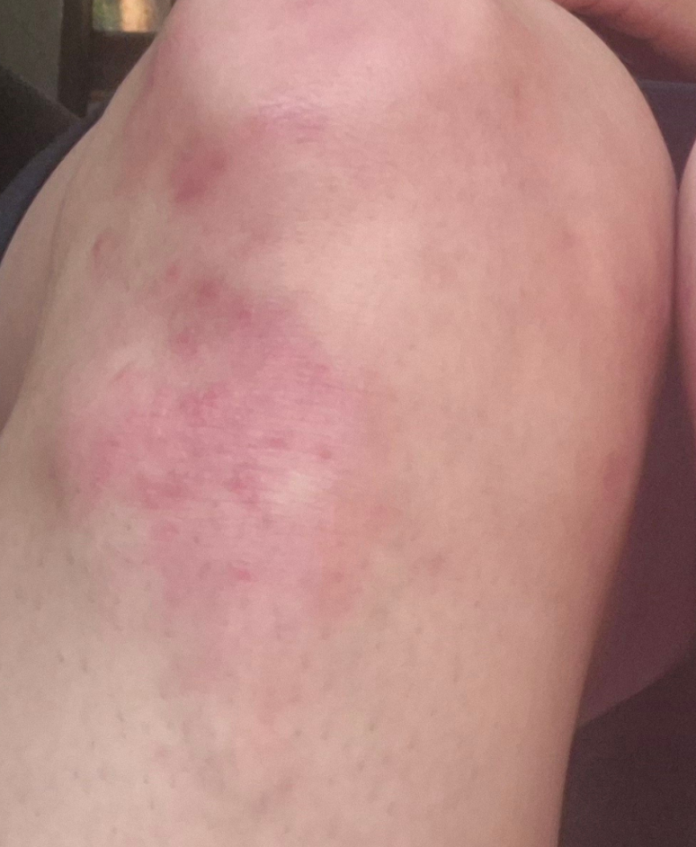 Visible reduction of psoriasis symptoms after home phototherapy with UV Tactus UVB machine