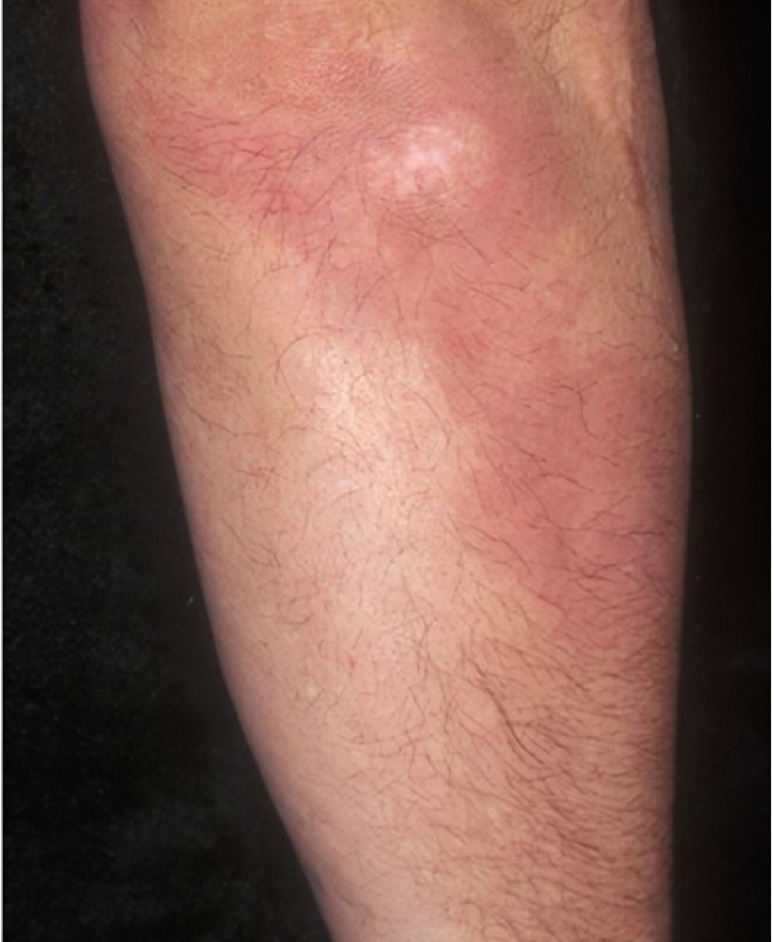 Psoriasis: Results of psoriasis treatment for 3.5 months with the UV Tactus medical device