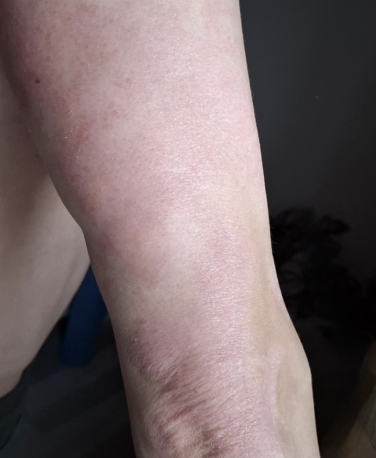 Reduced redness and itching after treating psoriasis for 2 months with UV Tactus UVB light