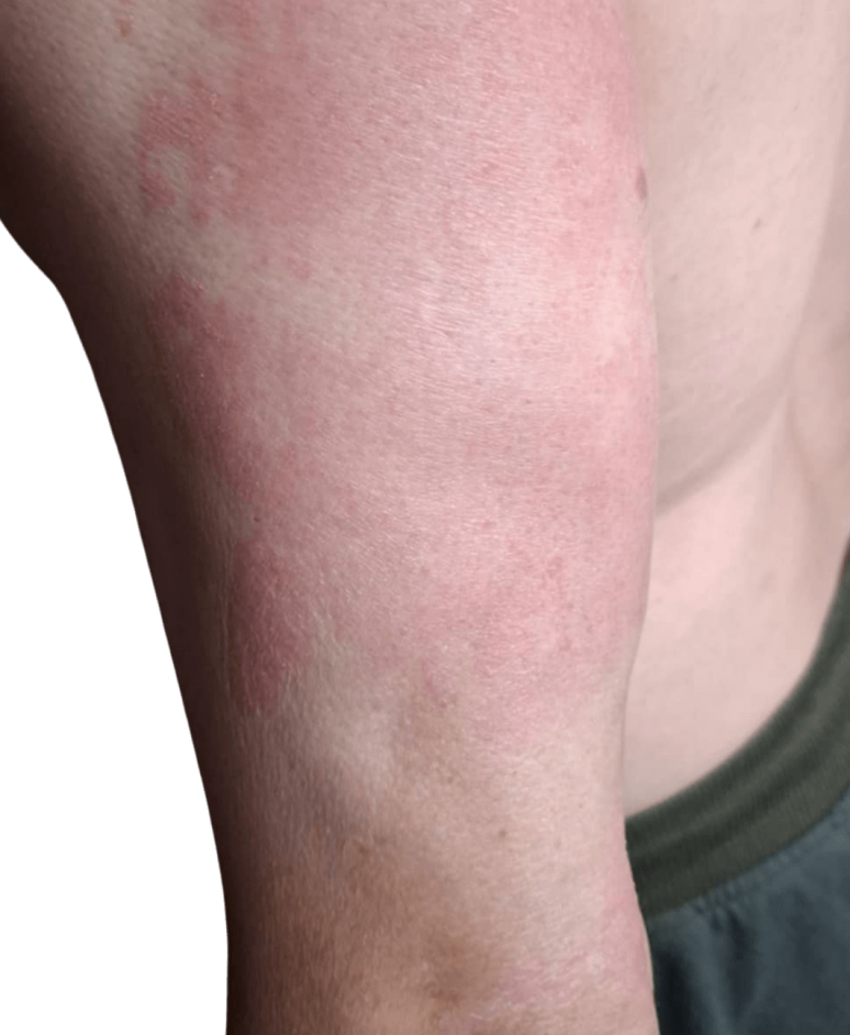 Reduced redness and itching after treating psoriasis for 2 months with UV Tactus UVB light