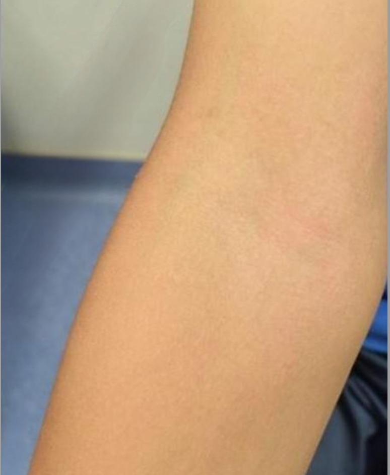 Eczema: Results of eczema treatment for 1 month with UV Tactus