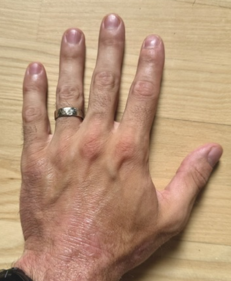 Eczema: Results of eczema treatment on hands for 8 weeks with the UV Tactus narrowband UVB phototherapy device at home
