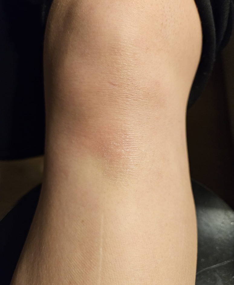 Psoriasis: Results of psoriasis treatment for 1 month with UV Tactus