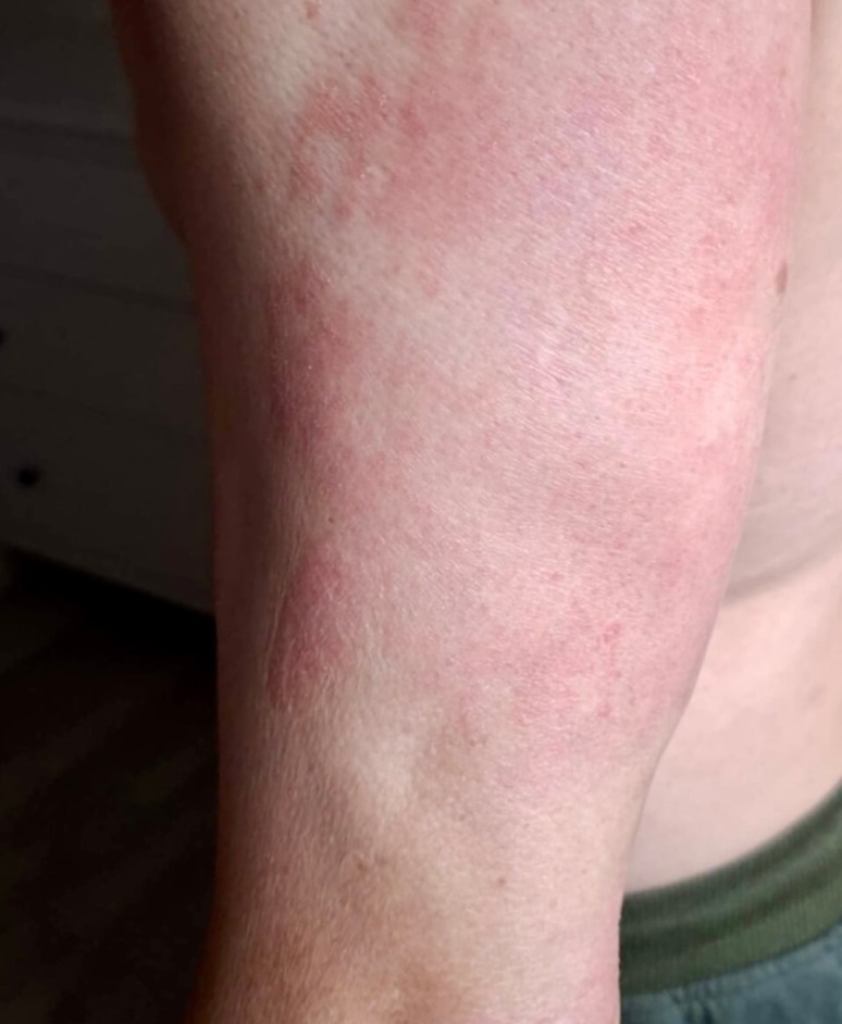 Reduced redness and itching after treating psoriasis for 2 months with U
