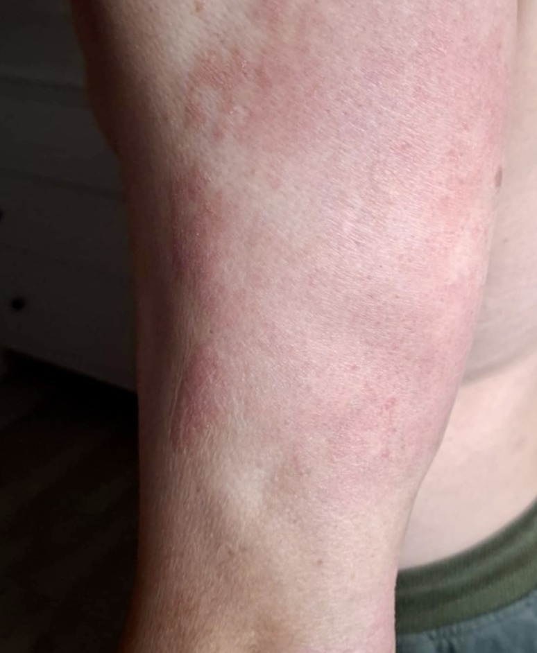 Reduced redness and itching after treating psoriasis for 2 months with UV Tactus UVB light
