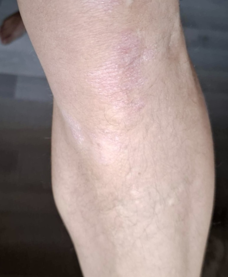 Psoriasis: Results of psoriasis treatment on knees for 1.5 months with UV Tactus