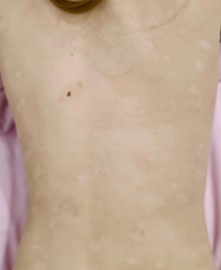 Cleared psoriasis on the back after 1.5 months treatment with advanced UV Tactus home phototherapy