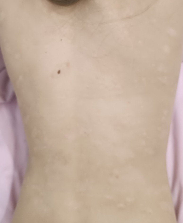 Cleared psoriasis on the back after 1.5 months treatment with advanced UV Tactus home phototherapy