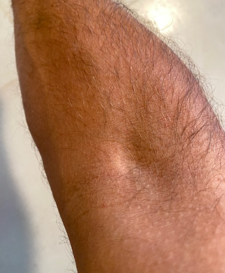 Eczema: Results of eczema treatment for 1 month with UV Tactus