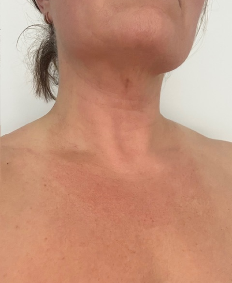 Visible Dermatitis results after 2 weeks treatment with UV Tactus light therapy