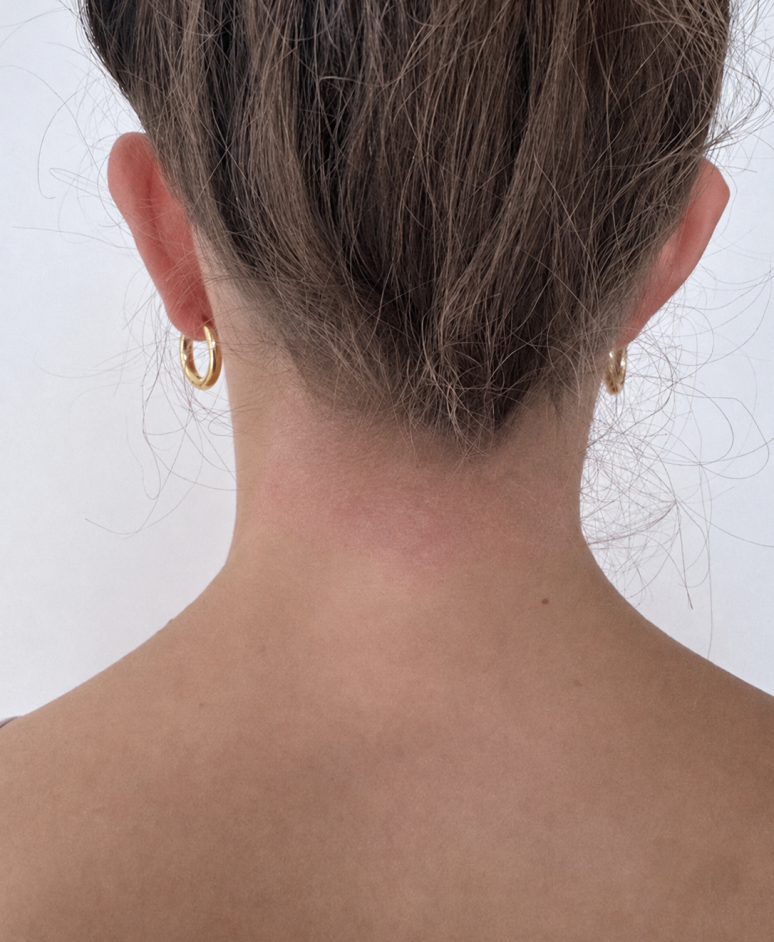 UVB light therapy results for treating scalp psoriasis with UV Tactus comb attachment